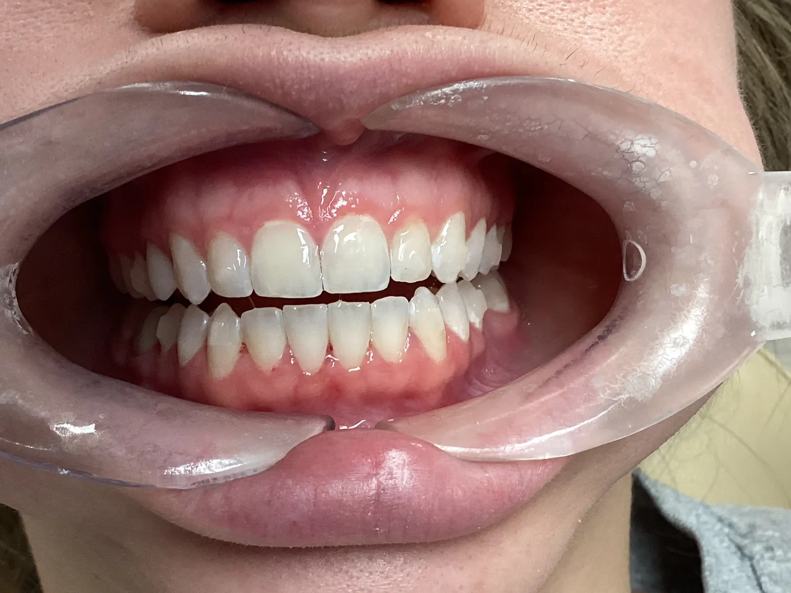 After Invisalign Treatment